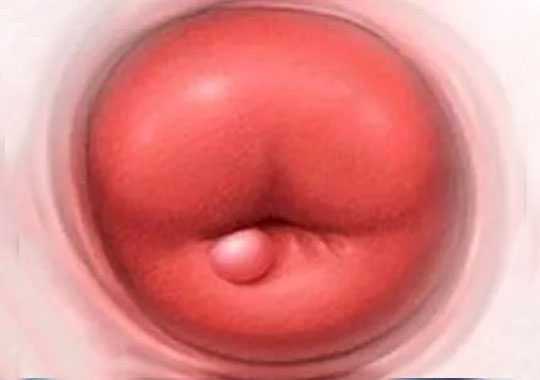 子宫囊肿是什么?插图 子宫囊肿是什么?插图