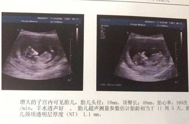 测男孩女孩最准的方法清宫表是怎样的？四维单子上有什么标志生男孩？插图1