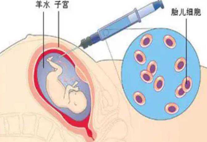 羊水穿刺能看出怀的是男孩还是女孩吗？插图