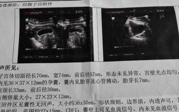 b超有两点基本是男孩?快拿出你的b超来对照一下吧?插图 b超有两点基本是男孩?快拿出你的b超来对照一下吧?插图