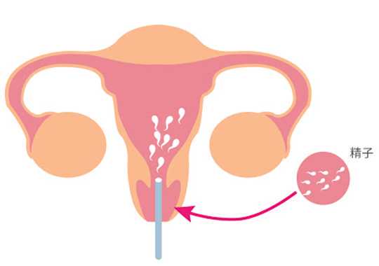 人工授精(IUI)插图
