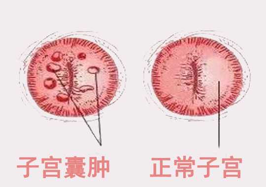 子宫囊肿是怎么形成的?插图 子宫囊肿是怎么形成的?插图