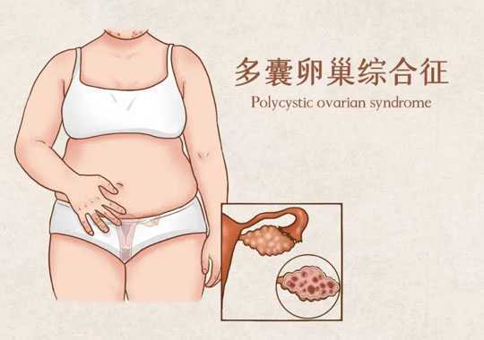 多囊卵巢综合征还能治好吗?插图 多囊卵巢综合征还能治好吗?插图