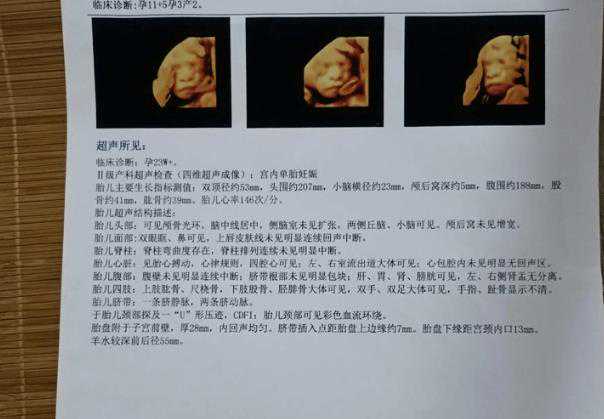 网传四维彩超暗示生男女?如何从单子上看出胎儿性别的?插图 网传四维彩超暗示生男女?如何从单子上看出胎儿性别的?插图