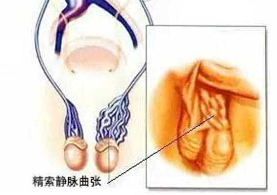精索静脉曲张症状有哪些?插图 精索静脉曲张症状有哪些?插图