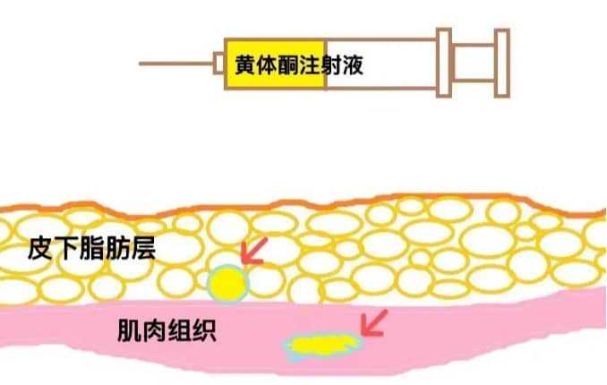 艾滋病做试管婴儿要花多少钱？我帮你算算账插图