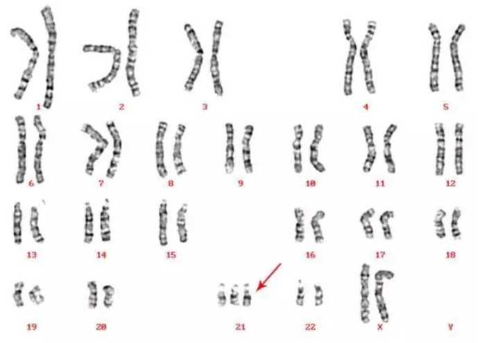 宫腔粘连怀孕后要注意的事插图