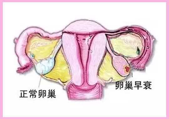 卵巢早衰(POF)插图
