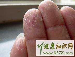 宝宝手指脱皮怎么办如何预防手指脱皮插图