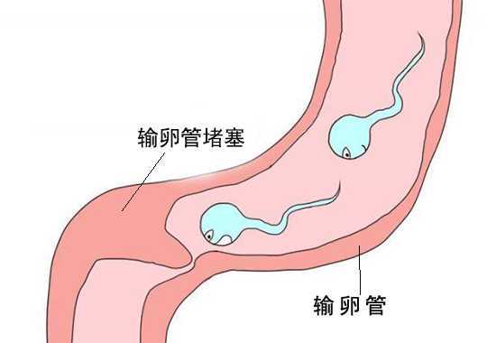 输卵管因素不孕症的诊断和治疗插图 输卵管因素不孕症的诊断和治疗插图