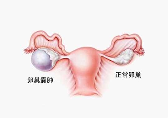 卵巢囊肿(ovariancysts)插图
