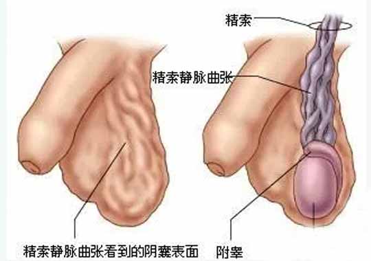 精索静脉曲张插图 精索静脉曲张插图