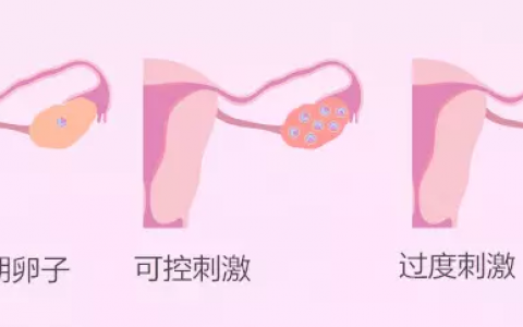 疤痕子宫做试管能怀双胞胎吗？可以放两个胚胎吗？插图