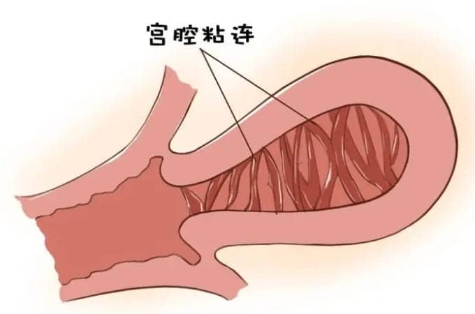 小腹拔罐能治宫寒吗？宫寒该怎么调理插图