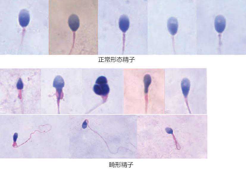 精子畸形怎么检查，如何治疗？插图