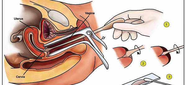 宫颈刮片和tct在准确率方面有什么区别?插图 宫颈刮片和tct在准确率方面有什么区别?插图