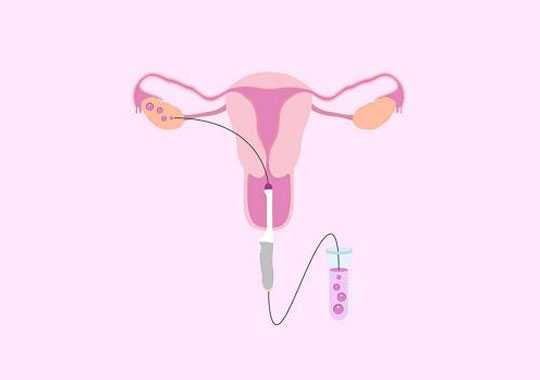 取卵手术后应注意什么?插图
