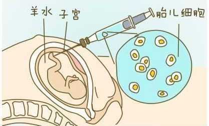 三代试管婴儿还必须做羊水穿刺吗？插图1