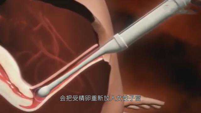 女性做试管婴儿过程很痛苦吗？做试管婴儿详细步骤！插图