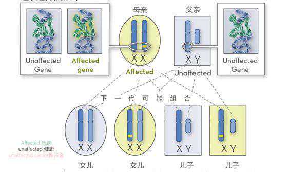 假肥大性肌营养不良能否通过第三代试管婴儿技术避免遗传?插图 假肥大性肌营养不良能否通过第三代试管婴儿技术避免遗传?插图