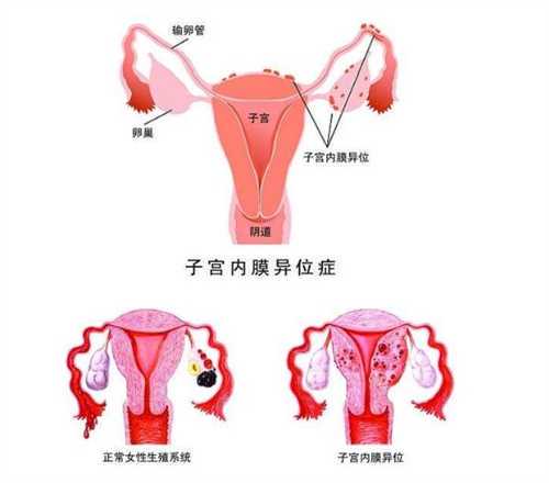 做试管婴儿大约要多少钱？两侧输卵管切除后能做试管婴儿吗？插图