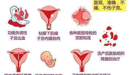 宫腔镜术后注意8大点,检查出宫腔粘连应立即治疗插图1 宫腔镜术后注意8大点,检查出宫腔粘连应立即治疗插图1