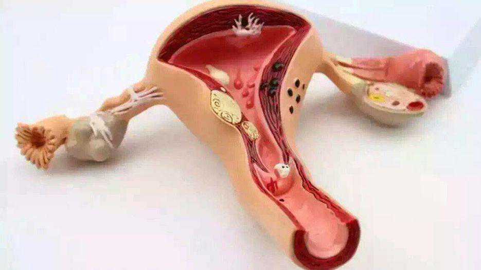 一文解析：子宫肌腺症能否做试管吗？试管成功率高吗？插图