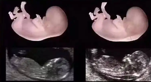 nt增厚是什么意思,为什么会出现NT增厚插图 nt增厚是什么意思,为什么会出现NT增厚插图
