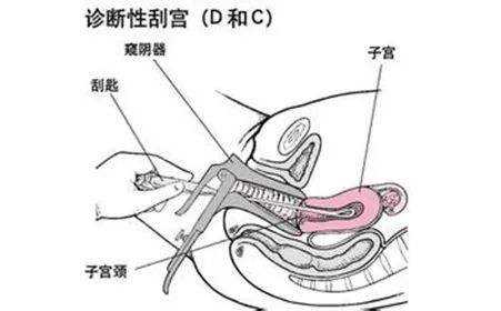 第一次试管婴儿移植失败后必须刮宫吗？插图1