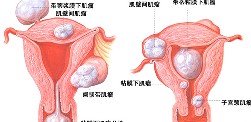 子宫肌瘤试管婴儿助孕？掌握这些好孕更简单插图