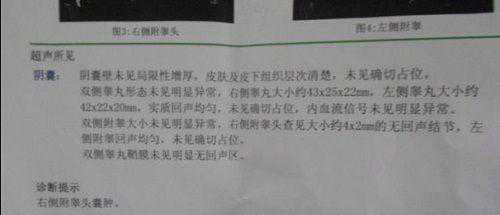 右侧附睾囊肿插图 右侧附睾囊肿插图