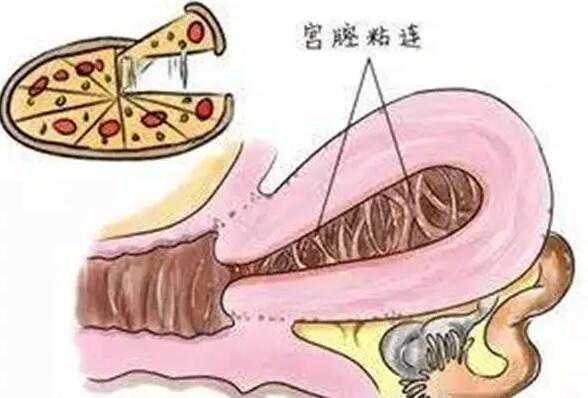 腺肌症能做试管吗?腺肌症试管能不能生孩子?插图2 1659252044586577.jpeg