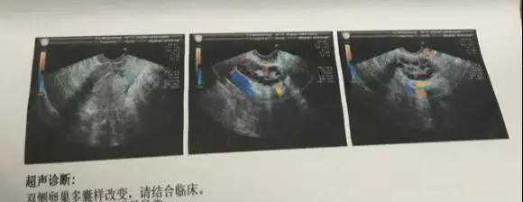 多囊6年不孕的我，历经2促4移，如何在34岁收获好孕？插图