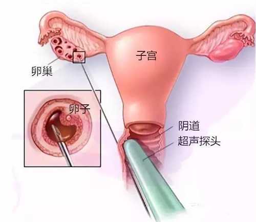 女同性做试管婴儿需要准备多少钱 美国女同试管费用参考插图