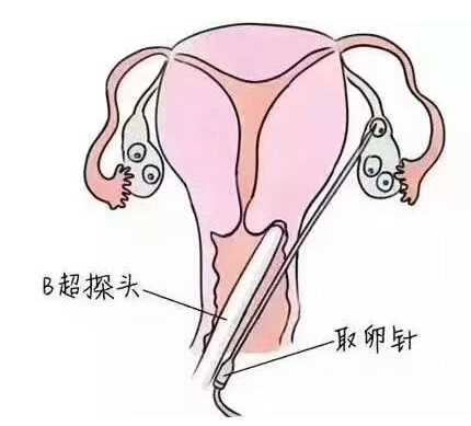 试管婴儿取卵无痛的真相是什么？取卵真的不痛吗？插图
