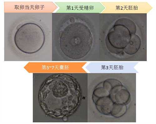 羊水穿刺后破水如何保胎 三代试管婴儿也必须做羊穿吗?插图 羊水穿刺后破水如何保胎 三代试管婴儿也必须做羊穿吗?插图