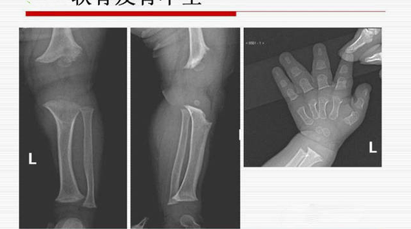 软骨发育不全怎么遗传?能通过三代试管婴儿避免吗?插图 软骨发育不全怎么遗传?能通过三代试管婴儿避免吗?插图