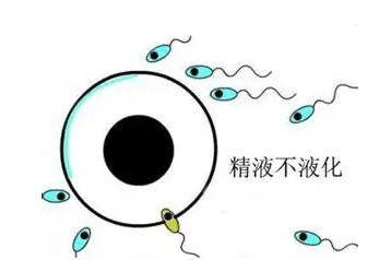 哪些因素会导致男性精液不液化？精液不液化如何治疗插图
