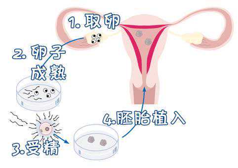 第三代试管婴儿的大概流程是怎样的插图 第三代试管婴儿的大概流程是怎样的插图