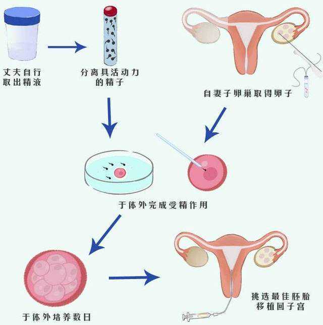 试管婴儿的整个过程是什么？都有哪些步骤！插图