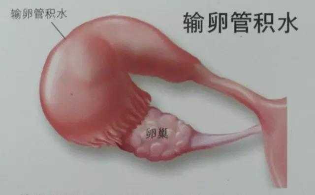 输卵管积水会影响试管婴儿成功率吗？插图