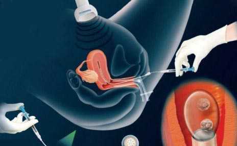 什么人做试管婴儿容易成功？专家说：这类人做试管成功率高插图