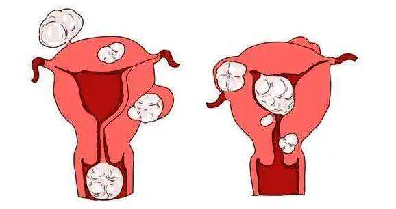 有腺肌症和腺肌瘤能做试管吗?腺肌症试管可行吗?插图2 1659251997226867.jpeg