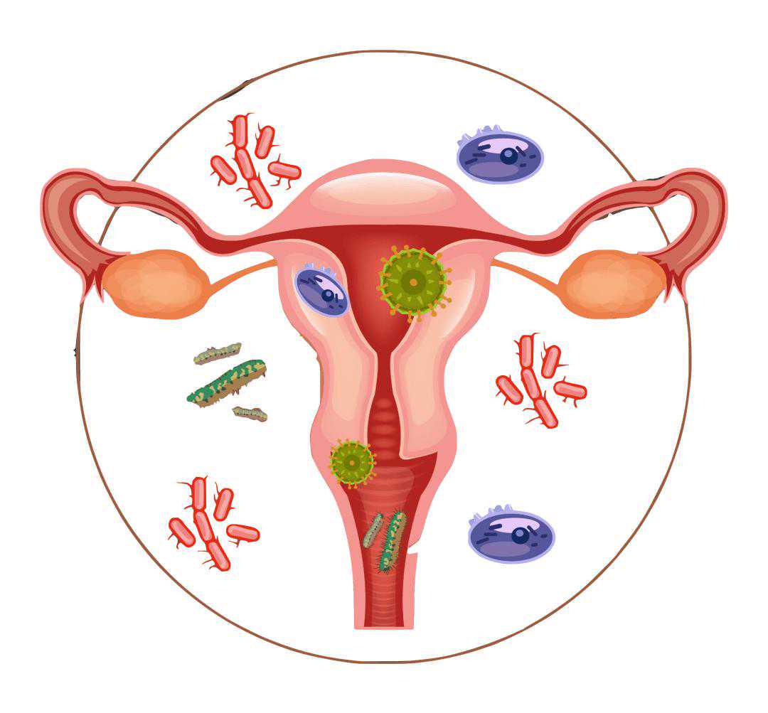 盆腔炎可以做试管婴儿吗插图 盆腔炎可以做试管婴儿吗插图