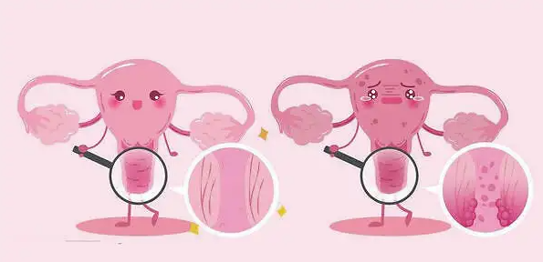 宫颈糜烂会出现哪些症状，应该如何预防宫颈糜烂插图