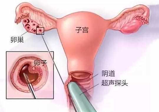 取卵方式有几种?插图