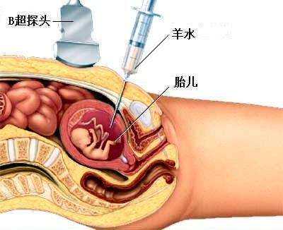 三代试管婴儿还必须做羊水穿刺吗？插图