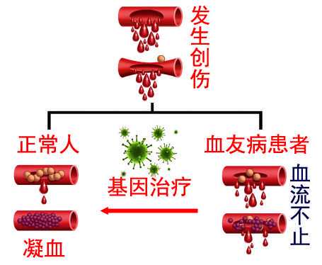 血友病携带者可以做试管婴儿吗?要多少钱?插图1 血友病携带者可以做试管婴儿吗?要多少钱?插图1