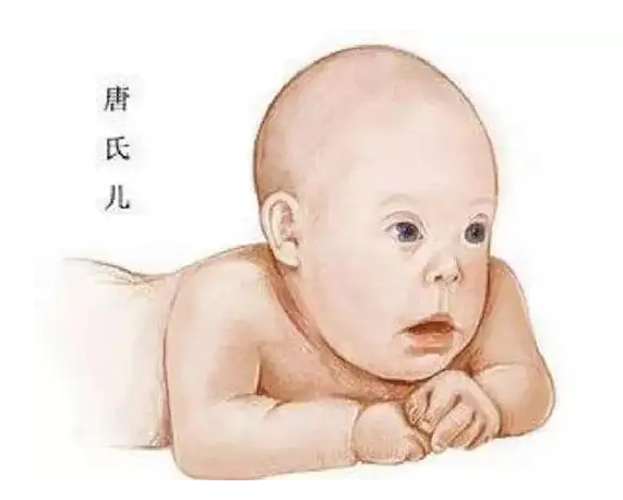 那些孕妇容易怀上患有唐氏综合症的宝宝插图 那些孕妇容易怀上患有唐氏综合症的宝宝插图