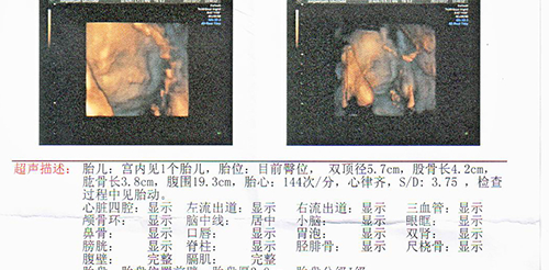 判断生男女小窍门!四维彩超看胎儿性别方法分享插图2 判断生男女小窍门!四维彩超看胎儿性别方法分享插图2